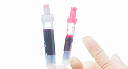 PRP·PRF 임플란트